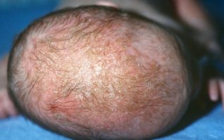 Seborrheic_dermatitis